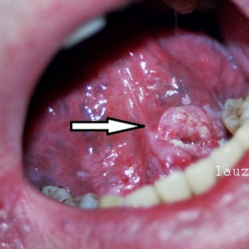 Carcinoma Epidermoide de boca